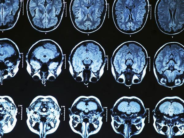 некоторые участки мозга отличаются у страдающих ОКР по сравнению обычными людьми