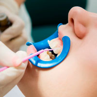 Нанесение стоматологического лака