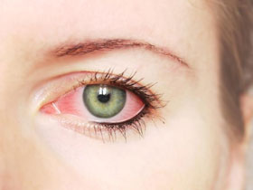 Сухие глаза могут стать красными и раздраженными.
