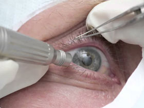 Хирургия глаза может исправить некоторые проблемы, которые приводят к сухости глаз