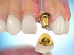 Что такое зубной имплантат?