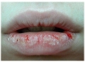 Потрескавшиеся губы (хейлит) - симптомы и признаки