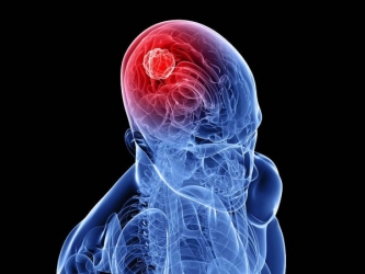 Опухоль головного мозга - симптомы и признаки