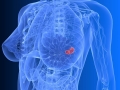 Узлы в груди у женщин - симптомы и признаки