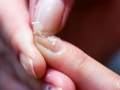 Ломкие ногти - симптомы и признаки