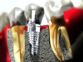 Лидеры производства зубных имплантов