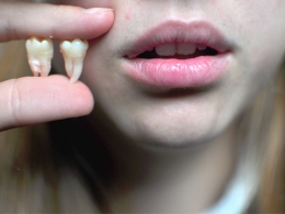Удаление зуба мудрости - показания и описание процедуры