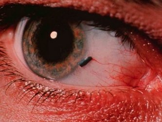 Инородное тело в глазу - симптомы и признаки