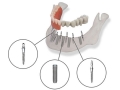 Что такое временный зубной имплантат