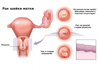 Рак шейки матки - симптомы и признаки