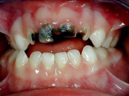 Кариес передних зубов: причины возникновения, особенности лечения