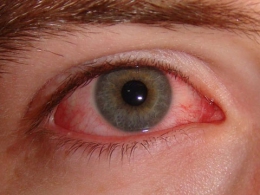 Лечение аллергии на глазах